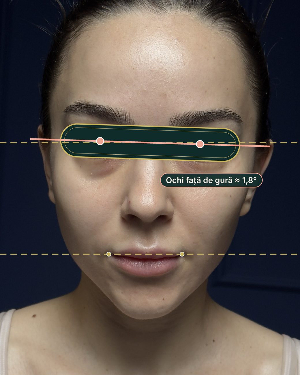 După masajul sculptural facial: linia ochilor mai apropiată de paralela cu linia gurii, aproximativ 1,8 grade