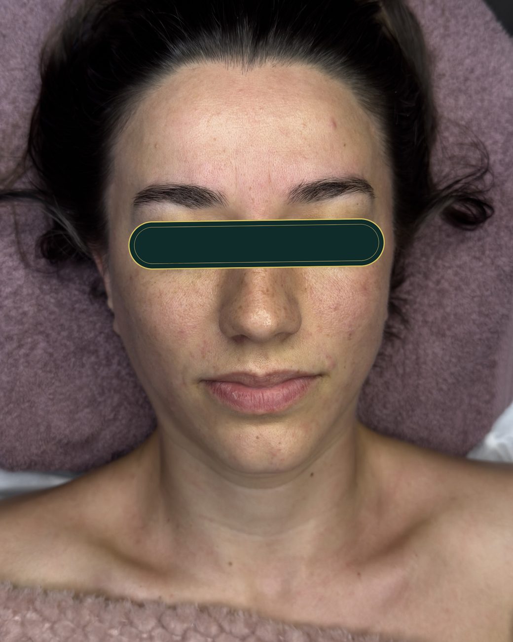 După masajul sculptural facial: frunte relaxată, contur mandibular mai definit