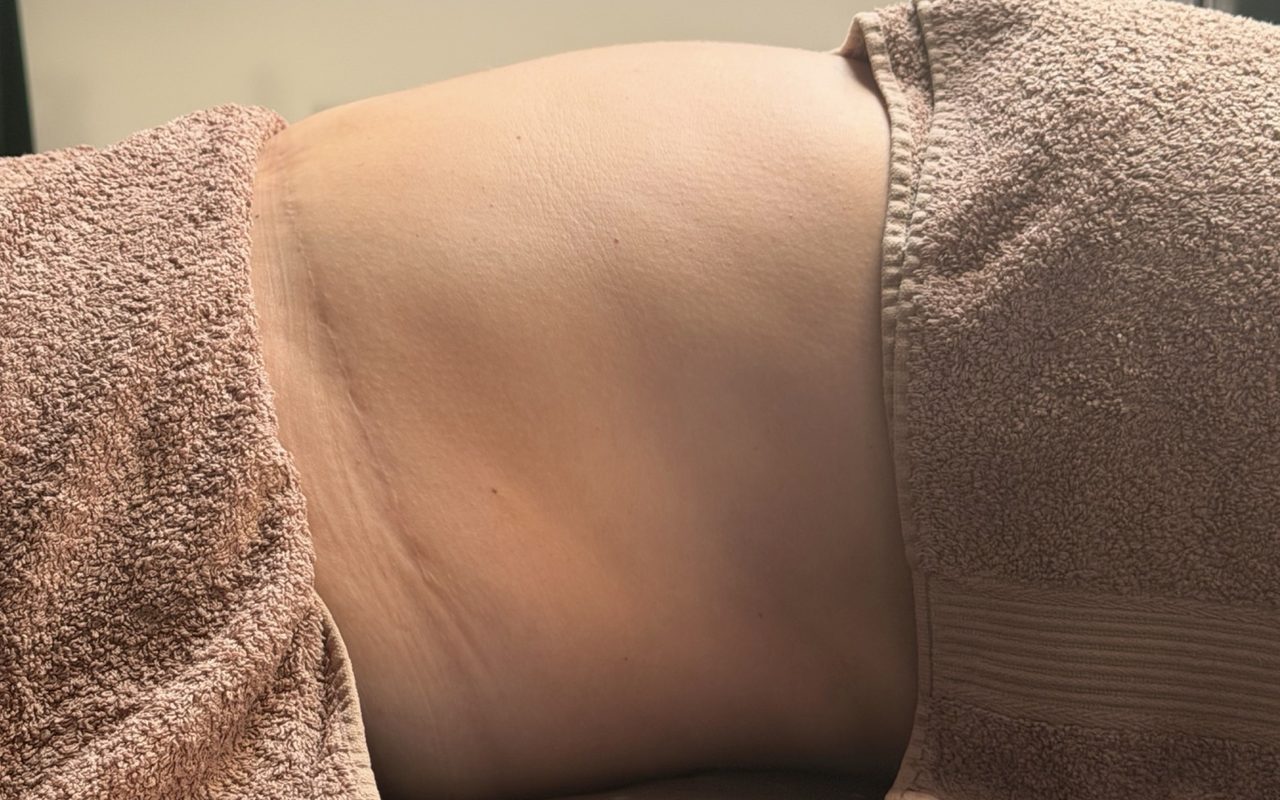Înainte de ritualul limfatic, abdomen din profil
