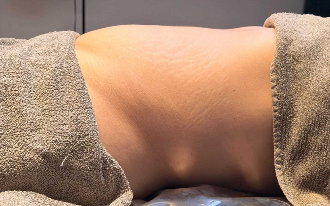 Înainte de ritualul limfatic, abdomen din profil