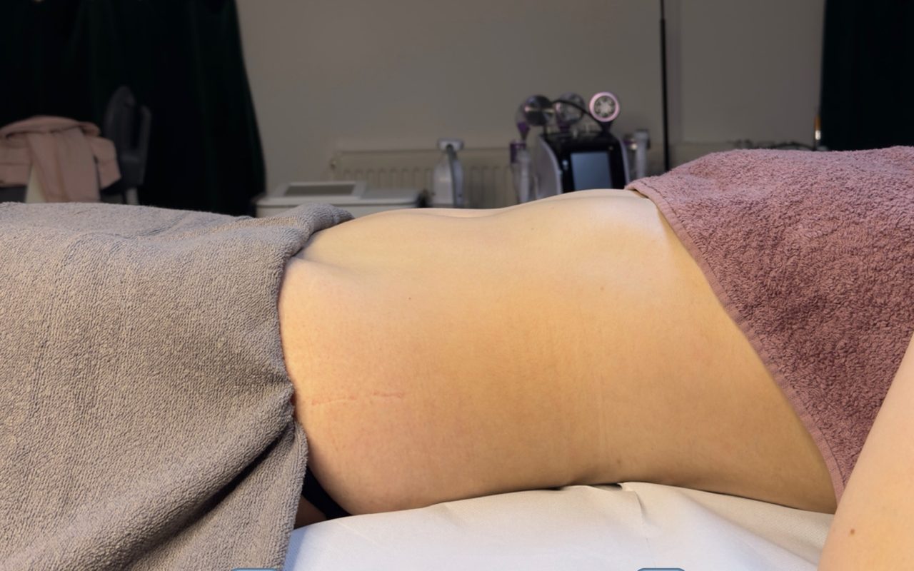 Înainte de ritualul limfatic, abdomen din profil