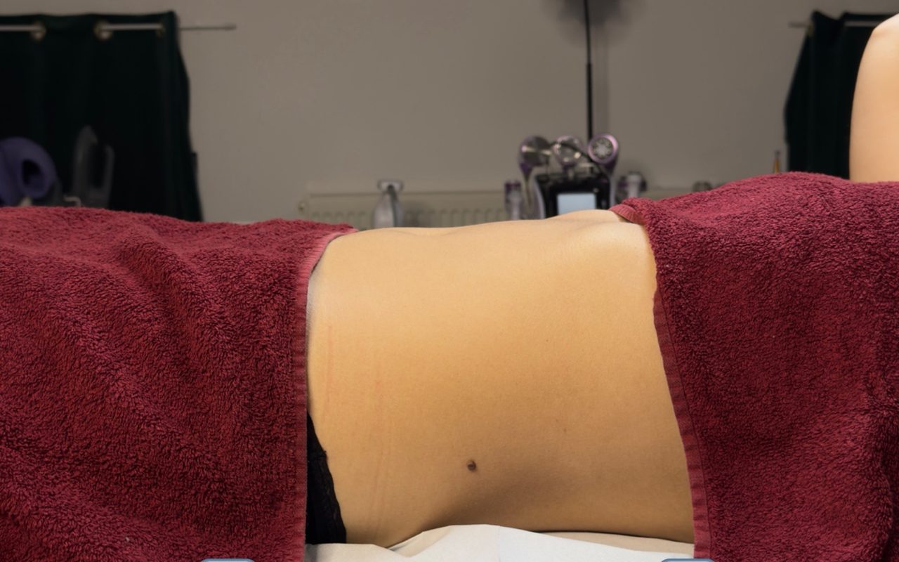 Înainte de ritualul limfatic, abdomen din profil